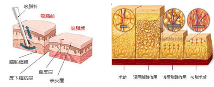 吸脂技术
